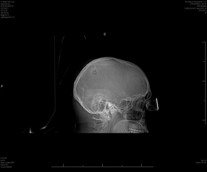 CT scan showing titanium plate used to repair my craniotomy.